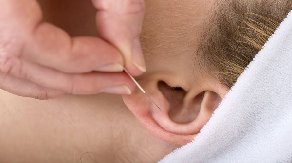 Close-up of acupuncture needle on an ear.