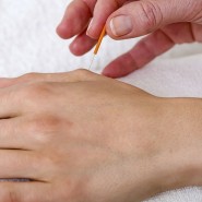 Acupuncture