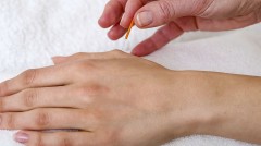 Acupuncture in hand